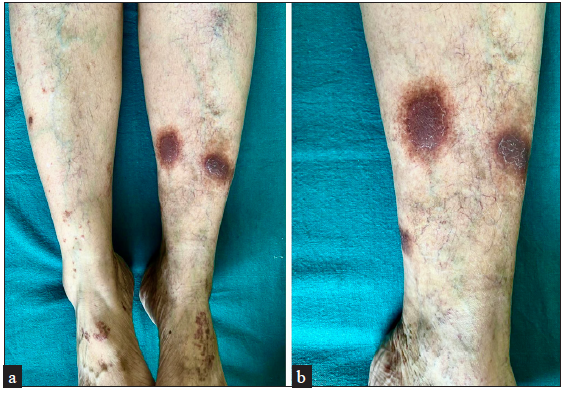Two prominent plaques showing a classic reddish-brown appearance surrounded by a yellowish-golden rim. Note the signs of venous flares surrounding these plaques.